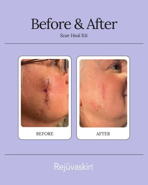 Timilk ReGenScar Cream – Advanced Scar Removal & Skin Repair Cream | Acne Marks, Stretch Marks & Spots Treatment