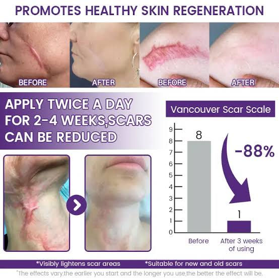 Timilk ReGenScar Cream – Advanced Scar Removal & Skin Repair Cream | Acne Marks, Stretch Marks & Spots Treatment